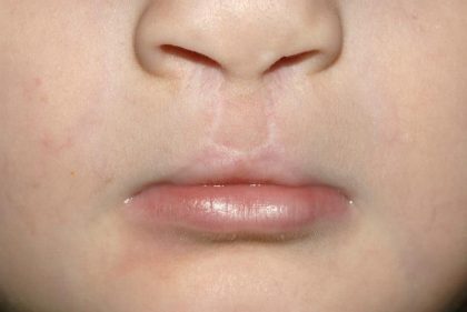 Cleft lip and palate Before & After Patient #1570