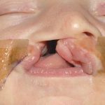 Cleft lip and palate Before & After Patient #1571