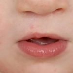 Cleft lip and palate Before & After Patient #1571