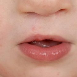 Cleft lip and palate Before & After Patient #1571