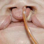 Cleft lip and palate Before & After Patient #1572