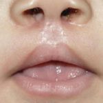 Cleft lip and palate Before & After Patient #1572