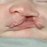 Cleft lip and palate Before & After Patient #1573