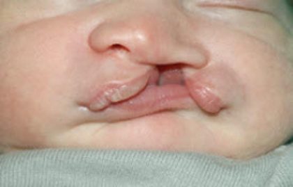 Cleft lip and palate Before & After Patient #1573