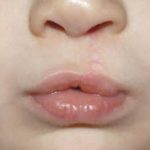 Cleft lip and palate Before & After Patient #1573