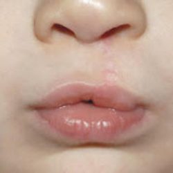 Cleft lip and palate Before & After Patient #1573