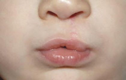 Cleft lip and palate Before & After Patient #1573