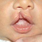 Cleft lip and palate Before & After Patient #1574