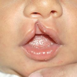 Cleft lip and palate Before & After Patient #1574