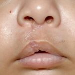 Cleft lip and palate Before & After Patient #1574