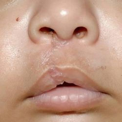 Cleft lip and palate Before & After Patient #1574