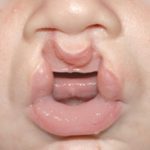 Cleft lip and palate Before & After Patient #1575