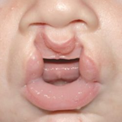 Cleft lip and palate Before & After Patient #1575