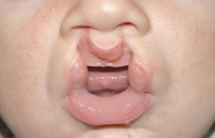 Cleft lip and palate Before & After Patient #1575
