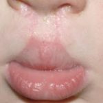 Cleft lip and palate Before & After Patient #1575