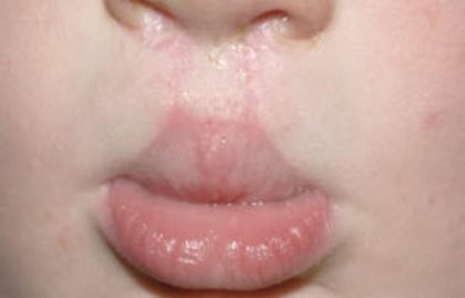 Cleft lip and palate Before & After Patient #1575