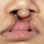 Cleft lip and palate Before & After Patient #1576