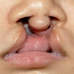 Cleft lip and palate Before & After Patient #1576