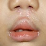 Cleft lip and palate Before & After Patient #1576