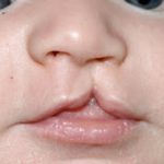 Cleft lip and palate Before & After Patient #1577