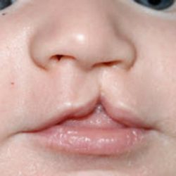 Cleft lip and palate Before & After Patient #1577