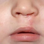Cleft lip and palate Before & After Patient #1577