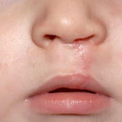 Cleft lip and palate Before & After Patient #1577