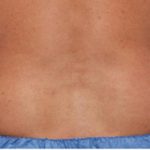Coolsculpting Before & After Patient #1640