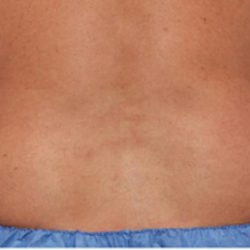 Coolsculpting Before & After Patient #1640