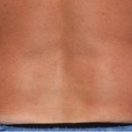Coolsculpting Before & After Patient #1640