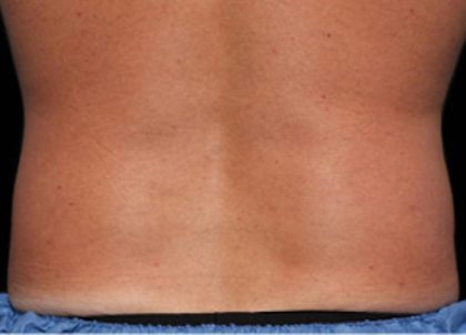 Coolsculpting Before & After Patient #1640