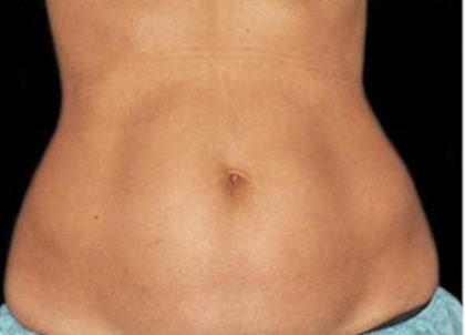 Coolsculpting Before & After Patient #1641