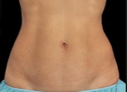 Coolsculpting Before & After Patient #1641