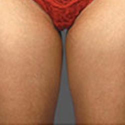 Coolsculpting Before & After Patient #1642