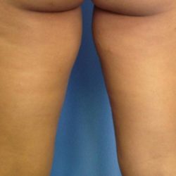 Coolsculpting Before & After Patient #1643