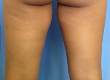 Coolsculpting Before & After Patient #1643