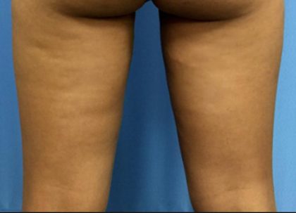 Coolsculpting Before & After Patient #1643