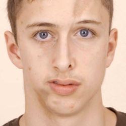 Craniofacial syndromes Before & After Patient #1579