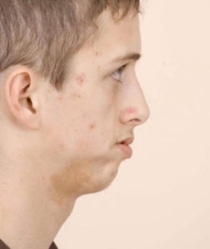 Craniofacial syndromes Before & After Patient #1579