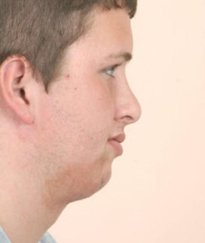 Craniofacial syndromes Before & After Patient #1579