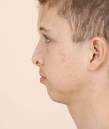 Craniofacial syndromes Before & After Patient #1579