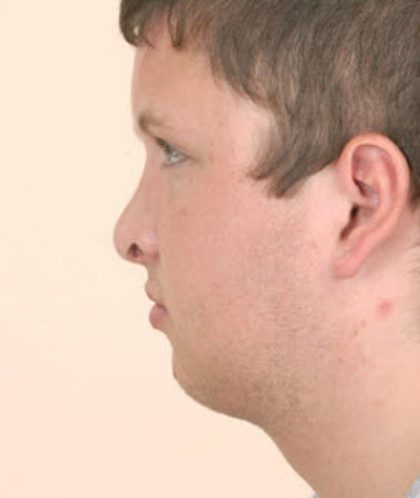 Craniofacial syndromes Before & After Patient #1579