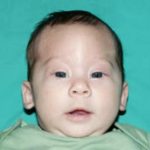 Craniosynostosis Before & After Patient #1580