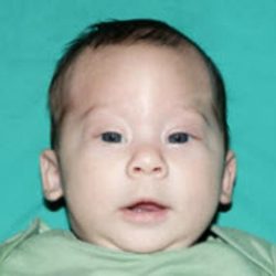 Craniosynostosis Before & After Patient #1580
