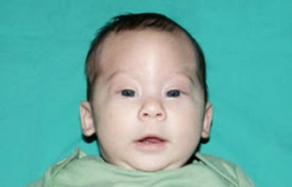 Craniosynostosis Before & After Patient #1580