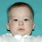 Craniosynostosis Before & After Patient #1580