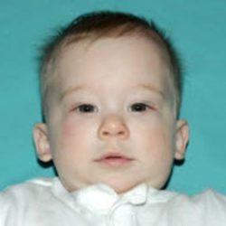 Craniosynostosis Before & After Patient #1580
