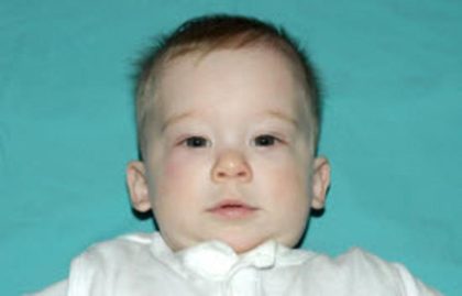 Craniosynostosis Before & After Patient #1580