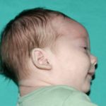 Craniosynostosis Before & After Patient #1580