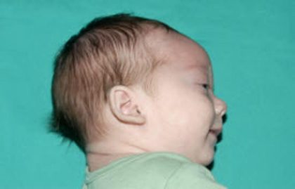 Craniosynostosis Before & After Patient #1580